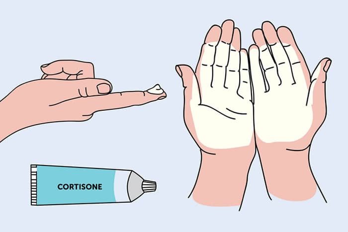 Illustration of a hand applying cortisone cream, with a tube labeled "Cortisone" and two hands showing cream applied to the palms.